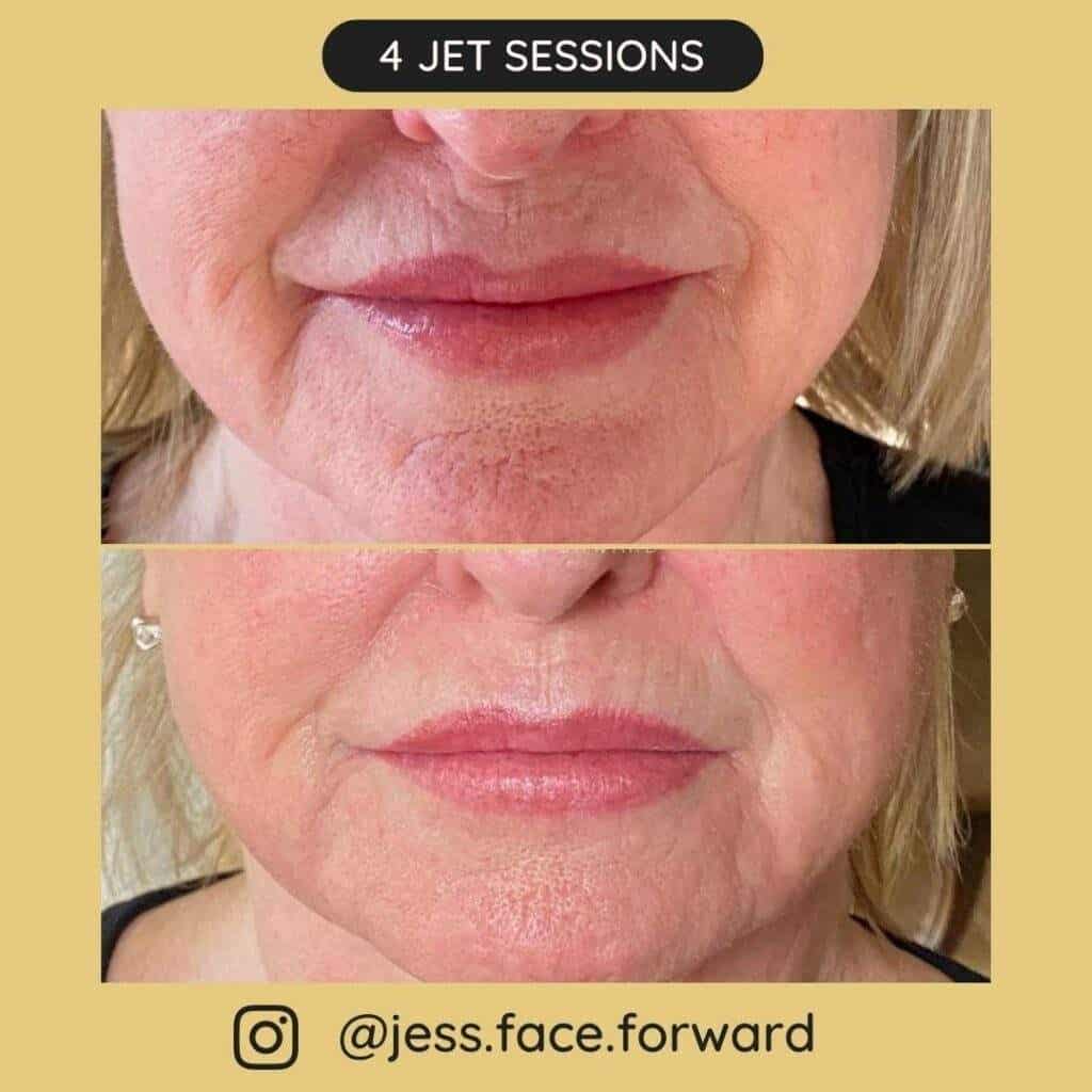 Before after sessions 10 1024x1024