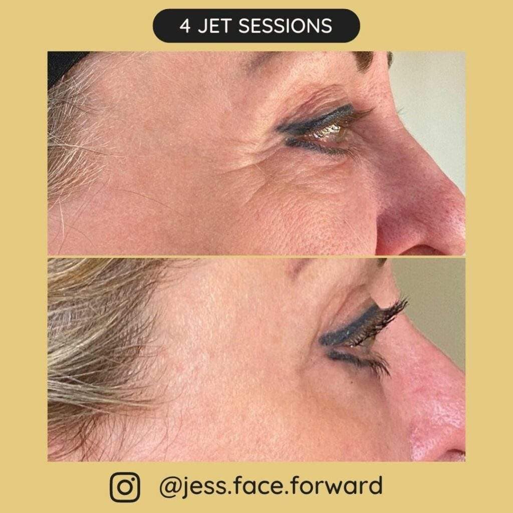 Before after sessions 11 1024x1024