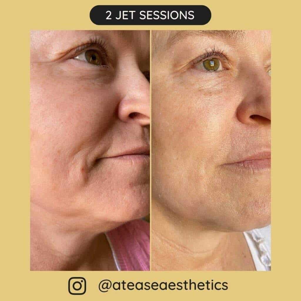 Before after sessions 12 1024x1024