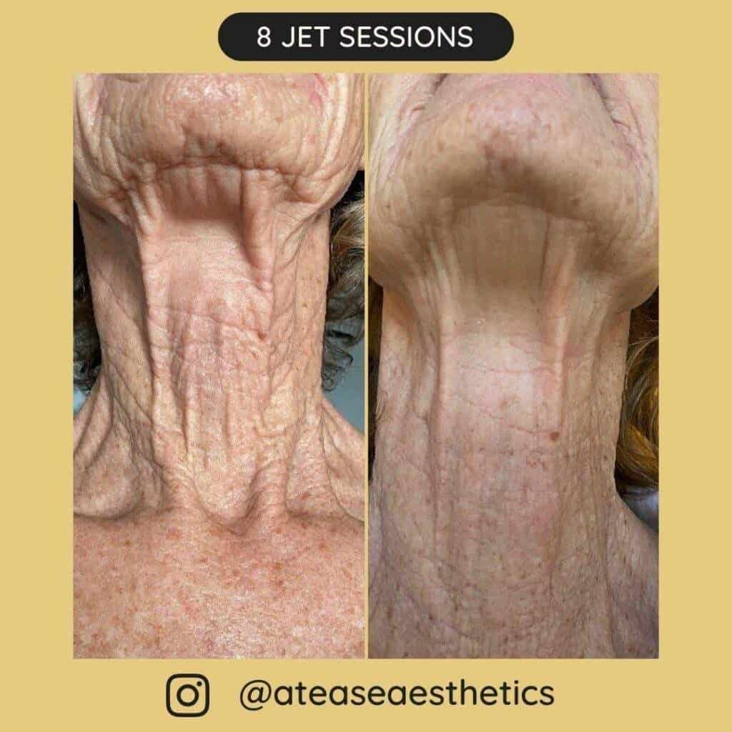 Before after sessions 13 1024x1024