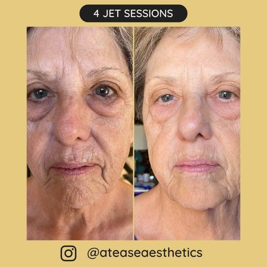 Before after sessions 14 1024x1024