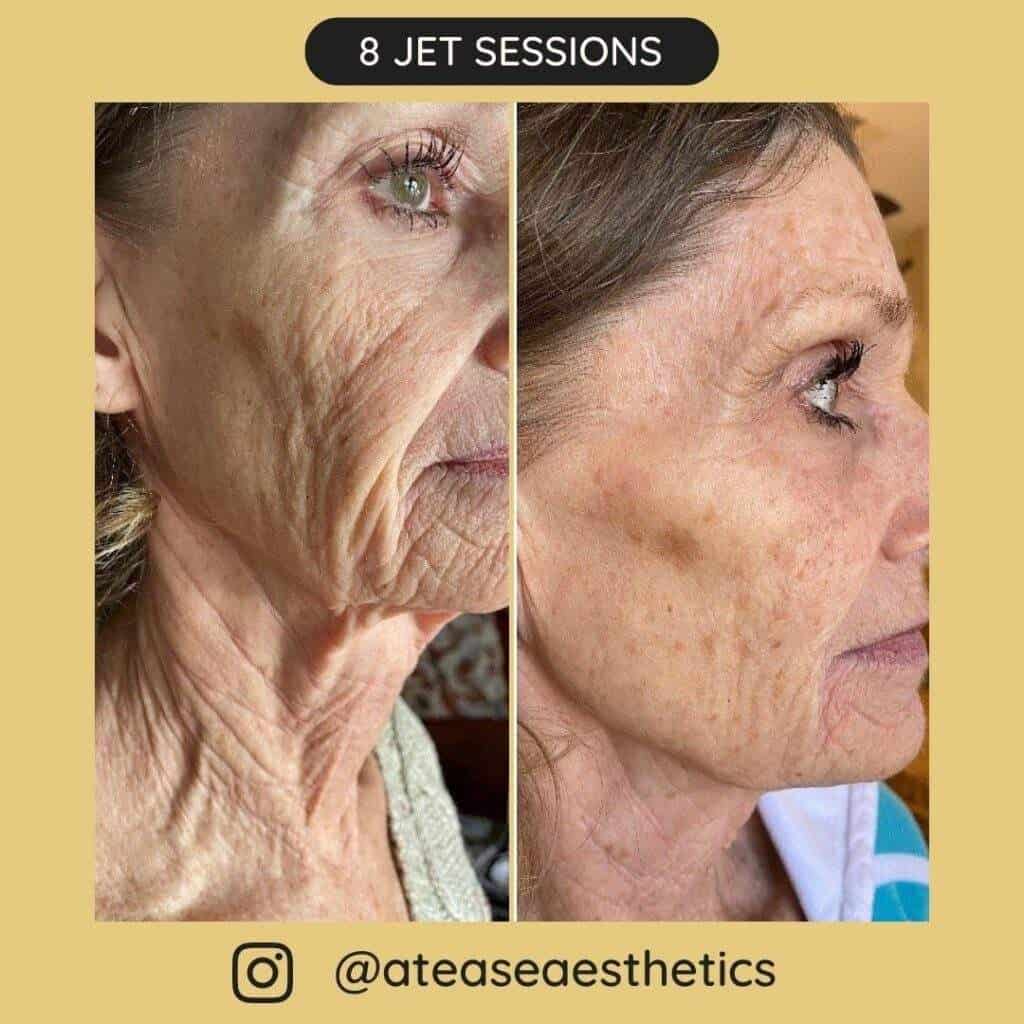 Before after sessions 4 1024x1024